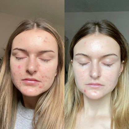 Retinol Gel 0.1% – Vitamin A Night Treatment